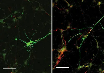 An APP-knockout neuron (right) shows extended axonal and reduced dendritic growth compared with a normal mouse neuron (left). Scale bar 50 µm.